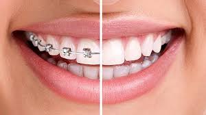 How much do become invisible braces cost? Dental Braces Types Cost And Procedure Nearby Dental