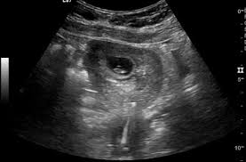 I ibd ibs ibw icd icf icp icu i&d iddm igt im inr i&o iud iv ivp ivpb ivda. Pregnancy With Intrauterine Contraceptive Device Radiology Reference Article Radiopaedia Org