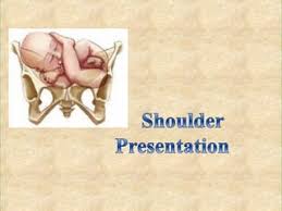 Image result for Shoulder Presentation