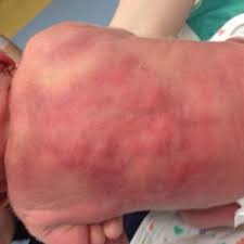 Erythematose Plaques Am Rucken Eines Neugeborenen