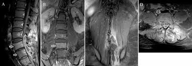 Image result for Spinal Epidural Abscess