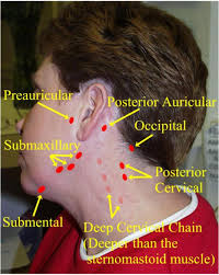 Swollen neck lymph nodes are enlarged lymph nodes in the neck area and under the chin. Swollen Neck Nodes