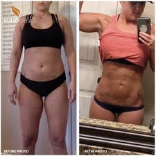 Sono Bello Before And After Could I Be Next Pattie Cordova Laser Liposuction Male To Female Transition Bello