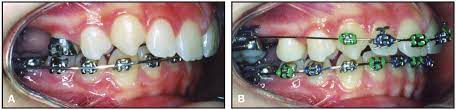 The clear choice for subtle corrections. Overview Upper Molar Distalization And The Distal Jet Jco Online Journal Of Clinical Orthodontics