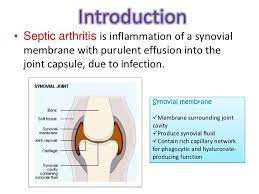 Introduction Septic Arthritis Is Inflammation Of A Synovial Membrane With Purulent Effusion Into The Joint Capsule Due Arthritis Synovial Fluid Inflammation