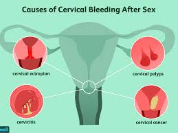 Individuals who have cervical cancer may experience severe back pain as a symptom of their disease. Postcoital Bleeding Why You May Bleed After Sex