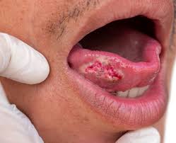 Image result for spinocellular carcinoma of the oral cavity
