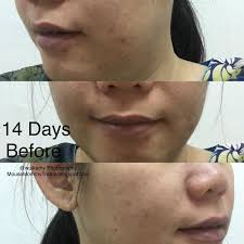 Clearing treatment has been specially formulated with 10% hydroxy acid that helps reduce black & whiteheads comedone at its root in 7 days. How Eucerin Proacne A I Clearing Treatment Solve My Problem Mouse Mommy Treats