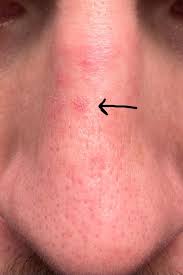 Image result for skin cancer on nose pimple