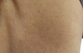 Image result for Notalgia Paresthetica