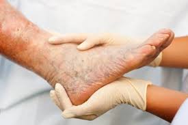 Because the venous procedure we do here at the advanced vein clinic is treating the medical cause of varicose veins, you will find varicose vein removal covered by insurance. Does Insurance Cover Vein Ablation Treatment Costs