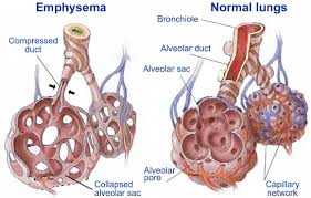 Image result for Emphysema