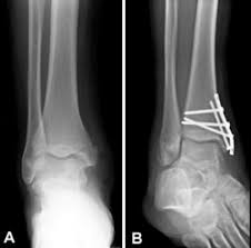 When people experience ankle fractures, this part of the bone is often involved. Ankle Fractures Broken Ankle Orthoinfo Aaos