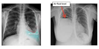 Image result for Parapneumonic Effusion