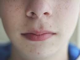 Blue Light Therapy Uses And Side Effects
