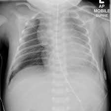 Xb2, xb4 and scx win at chi town shootout, usa. Respiratory Distress Syndrome Radiology Reference Article Radiopaedia Org