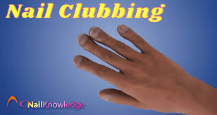 Image result for Digital Clubbing