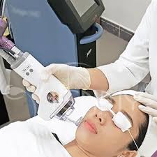 Khóa học trị sẹo rỗ công nghệ Laser CO2 vi phân