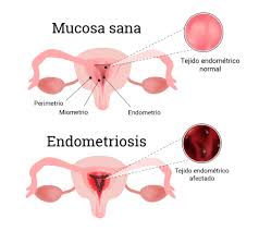 Resultado de imagen para ENDOMETRIOSIS