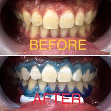 Mitali at pearl dental clinic indiranagar and they were really outstanding. Lai Dental Clinic Whitening Case For Today Shade A3 5 B1 Happy Dentistry Dental Dentist Whitening Smile White Doktorgigi Klinikgigi Laidentalclinic Yellow Pj Dj Klinikgigi Photography Putih Gigi Dentistmalaysia Facebook