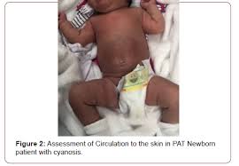 Image result for Neonatal Circulation Assessment
