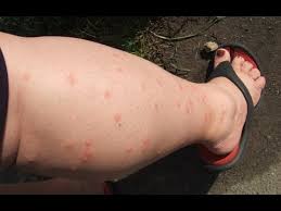 Apply ice to reduce inflammation and itching. Home Remedies To Get Rid Of Mosquito Bites Mosquito Bite Treatment Youtube