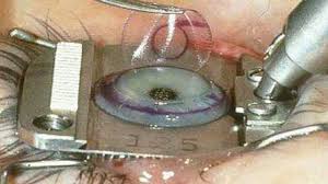 When a retinal tear or a detached retina is repaired with a surgical procedure vitrectomy surgery : Lasik Surgery Retinal Detachment Risk