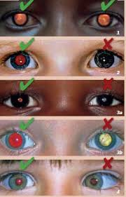 Image result for Red Reflex