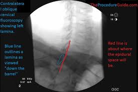 Image result for Lower Cervical Intramuscular Injection