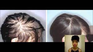 Diffuse hair loss from the scalp. Natural Hair Loss Treatment Check Your Iron Level Youtube