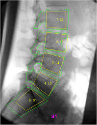 Free returns high quality printing fast shipping Investigator Analytic Repeatability Of Two New Intervertebral Motion Biomarkers For Chronic Nonspecific Low Back Pain In A Cohort Of Healthy Controls Chiropractic Manual Therapies Full Text