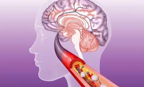 Aneurismas sintomáticos e aneurismas maiores que 5 cm precisam de tratamento operacional. Doppler Transcraniano Utilidade Casos De Aneurisma Cerebral