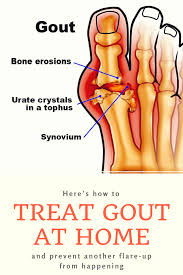 Here S How To Treat Gout At Home And Prevent Another Flare Up From Happening How To Treat Gout Home Remedies For Gout Gout Remedies