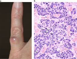 Image result for Merkel Cell Carcinoma