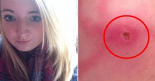 I thought it was freshers' flu': Student tells of horror after being  hospitalised by venomous spider bite