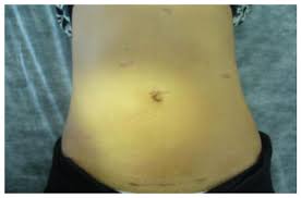 We did not find results for: Laparoscopic Hepatectomy For Benign Hepatic Lesions Short And Long Term Outcomes Including Quality Of Life Evaluation