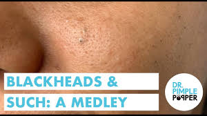 Dr pimple popper s04e05 dr lee nose best (youtube.com). Blackheads Such Youtube