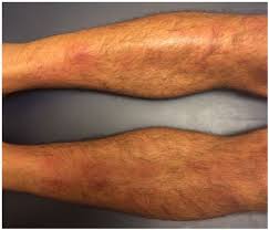 Image result for erythema nodosum