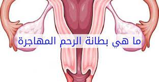 ما هي بطانة الرحم المهاجرة وأسبابها وأعراضها وعلاجها