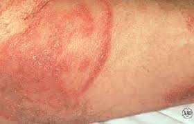 It can also be filled with pus to become yellow or clear. 13 Common Causes For Itchy Butt Rashes And Bumps According To Mds