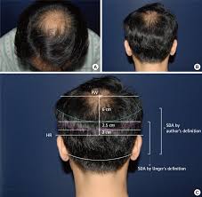 Hair loss for men in their 20s is far more common than you may realise. Case Of Anteriorly Positioned Pw A B A 45 Year Old Male With Male Download Scientific Diagram