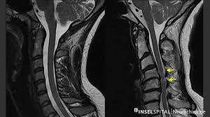 Zervikale Stenose Und Myelopathie Neurochirurgie Inselspital