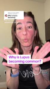 Dr Scott Walker Lupus