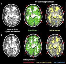 Grey matter (or gray matter) is a major component of the central nervous system, consisting of neuronal cell bodies, neuropil (dendrites and unmyelinated axons), glial cells (astrocytes and oligodendrocytes), synapses, and capillaries. Gray Matter And White Matter Segmentation Obtained Using Freesurfer Download Scientific Diagram