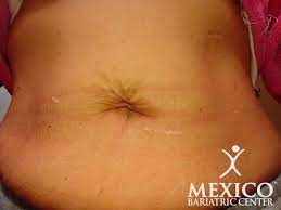 What your gastric sleeve scars will look like depends on how your procedure is performed for most gastric sleeve patients, the skin has been stretched out for so long to accommodate their extra weight that it has lost its elasticity. Gastric Sleeve Scars Guide To Reduce Scarring Quickly