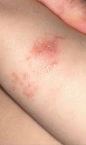 Image result for Eczema nummulare
