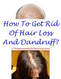 Pin On Info On Hair Loss