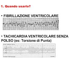 La fibrillazione ventricolare è un'aritmia caratterizzata da un'attivazione rapidissima ed irregolare delle camere inferiori del cuore (ventricoli) che diventa quindi incapace di. Interpretazione Dell Ecg Ppt Video Online Scaricare