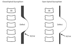Image result for Spinal Dysraphism