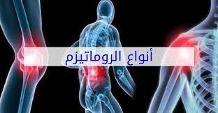 انواع الروماتيزم وأسبابه وعلاجه in 2021 lava lamp novelty lamp table lamp